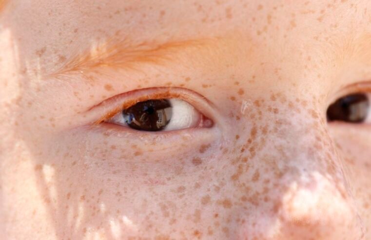 Reflexo branco nos olhos: entenda condição que assusta pais