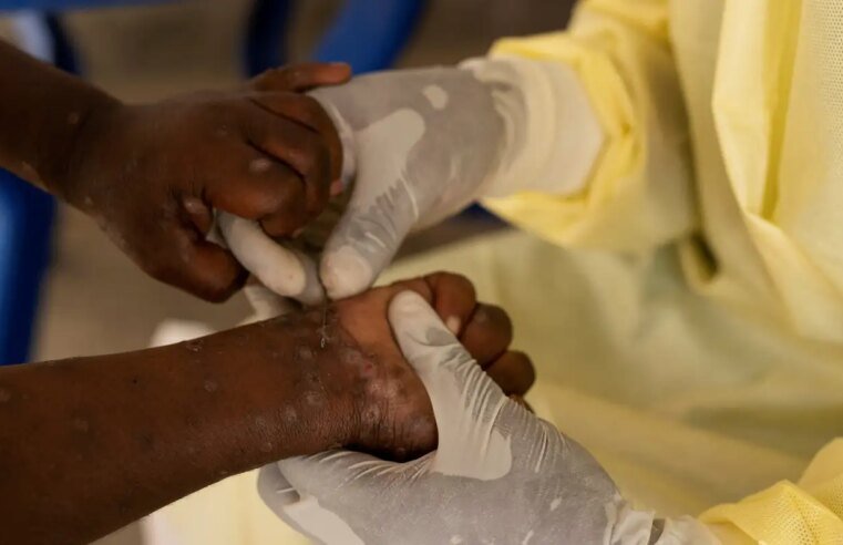 Brasil registra 88 casos de Mpox em 2026; saiba como evitar a doença