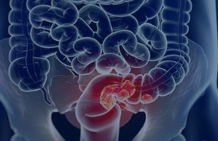 Rastreamento para câncer colorretal pode ser implementado no SUS