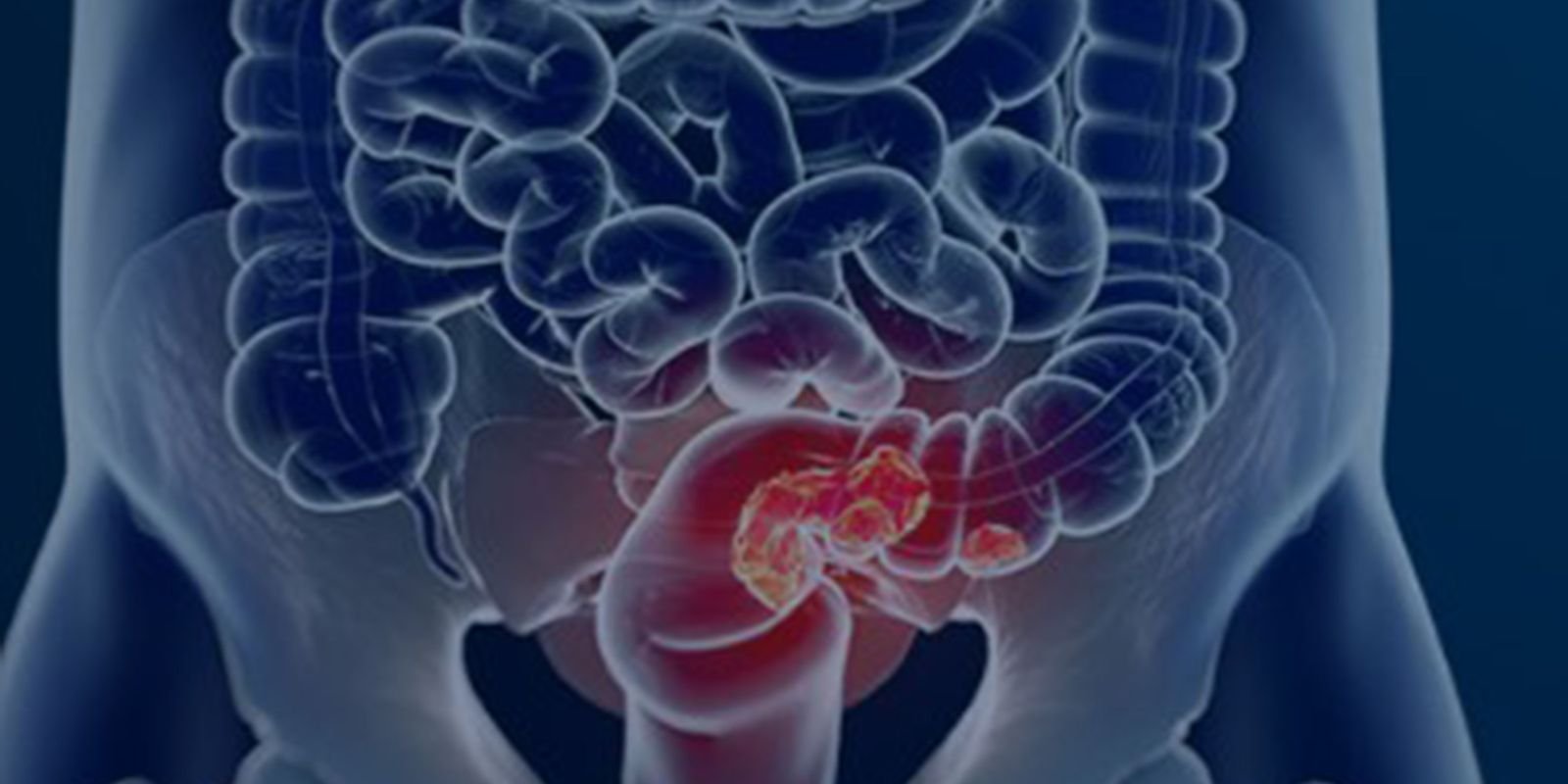 Rastreamento para câncer colorretal pode ser implementado no SUS