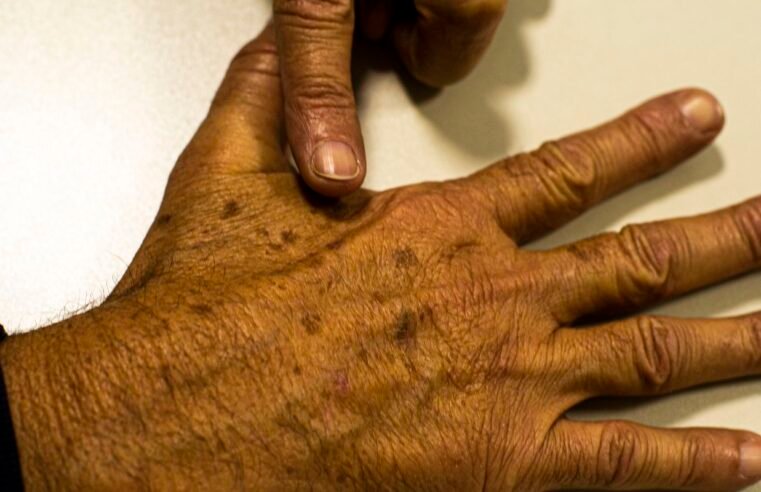 Desinformação sobre câncer de pele afeta diagnóstico, diz instituição