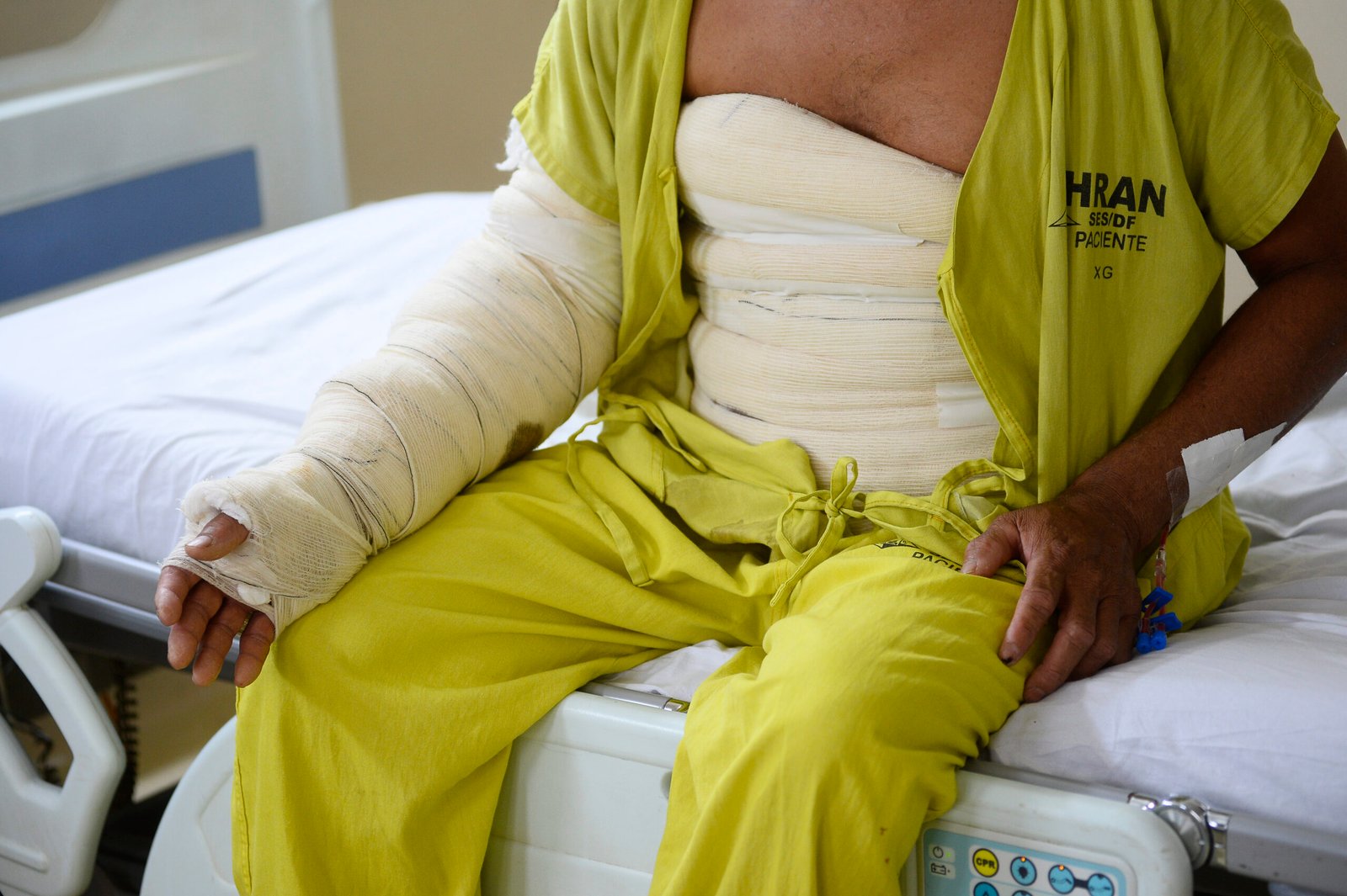 Hran reforça atendimento a vítimas de queimaduras no Junho Laranja