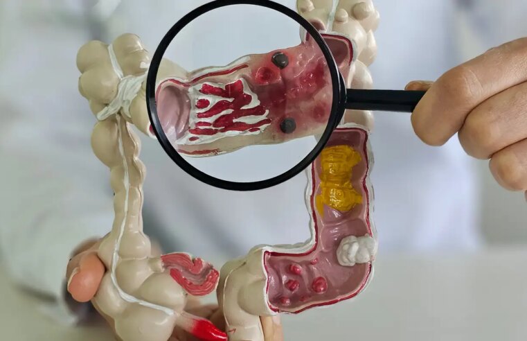 Em 13 anos, doença inflamatória intestinal cresce 5 vezes no Brasil