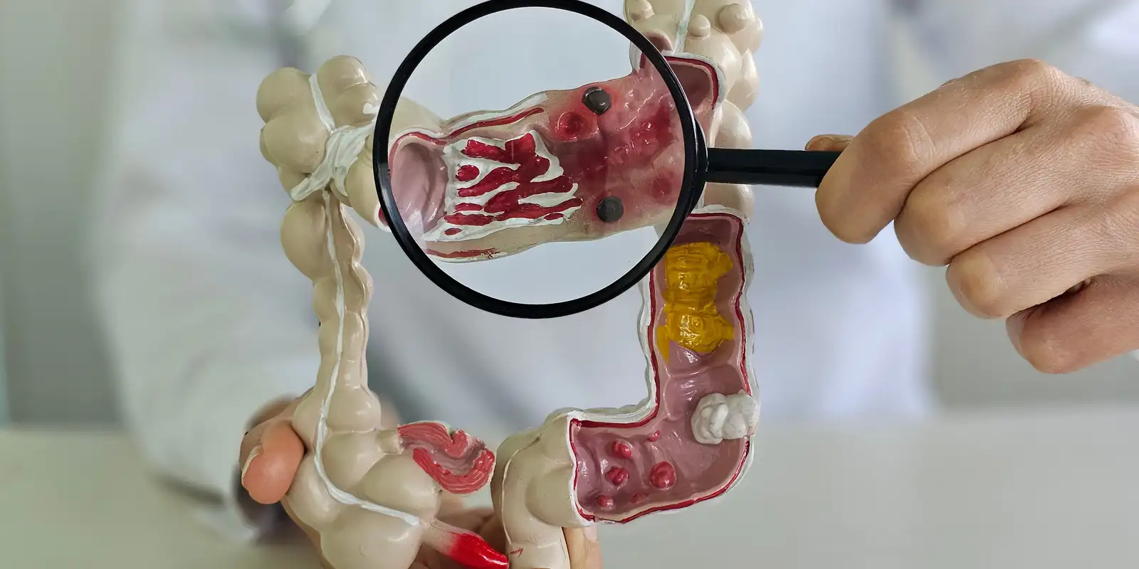 Em 13 anos, doença inflamatória intestinal cresce 5 vezes no Brasil